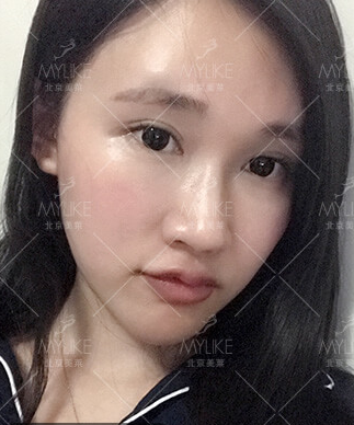 利来国际案例李莉对比图后