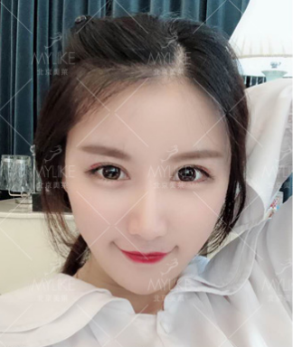利来国际案例李莉倩对比图后