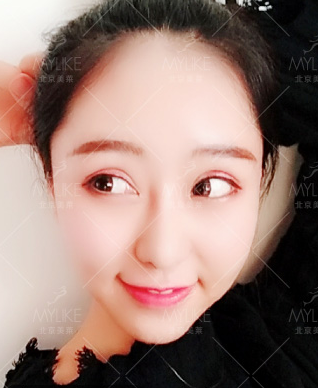 利来国际案例吕思佳对比图后