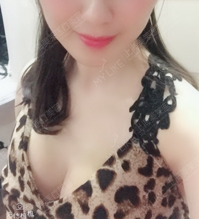Vicky复合丰胸