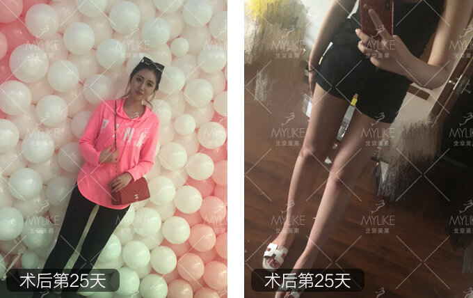 小岳岳呀大腿抽脂减肥+北京利来国际吸脂瘦腿案例
