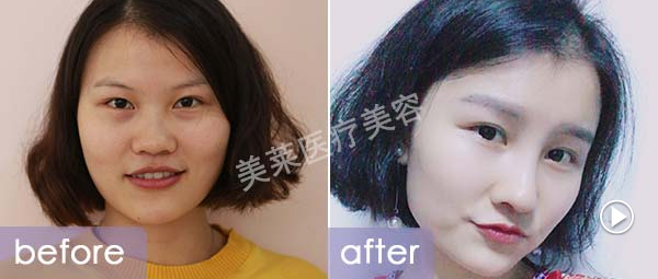 广州做<a href='/ybzx/syp/' target='_blank'><u>割双眼皮</u></a>手术哪种方法好