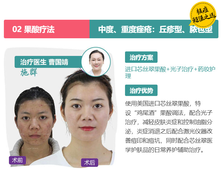 经常长痘，利来国际果酸祛痘效果怎么样