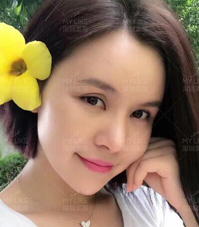 自体脂肪填充脸部做几次效果比较好