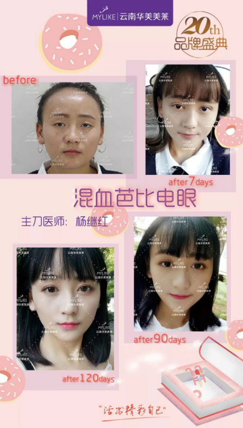 曲靖利来国际割双眼皮需要费用多少