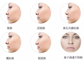 鼻子打玻尿酸后会变宽吗