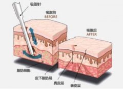 佛山利来国际手臂吸脂有副作用吗
