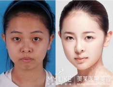 广州利来国际激光美白会有副作用吗