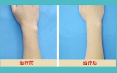 广州利来国际激光脱臂毛价格是多少