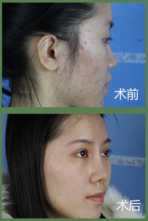 <a href='/gz/' target='_blank'><u>广州利来国际</u></a>祛痘印哪种产品好