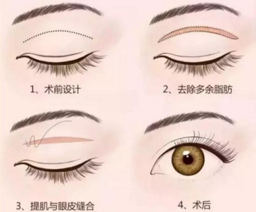 天津利来国际割双眼皮的疤痕怎么消除