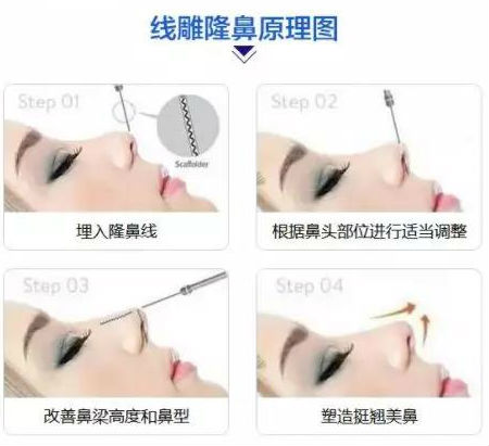 昆明大理做*雕隆鼻整形多少钱