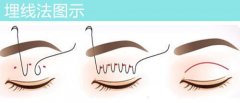 福州利来国际做埋线双眼皮维持多长时间