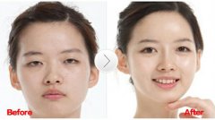 福州利来国际做埋线双眼皮的价格是多少