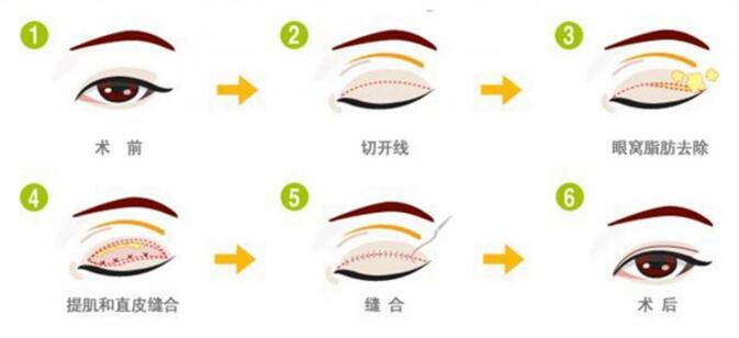 西安利来国际内双可不可以做全切双眼皮手术