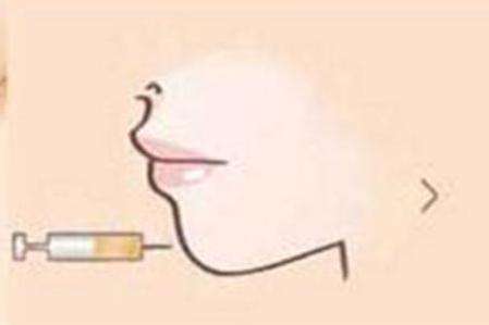 注射玻尿酸丰下巴