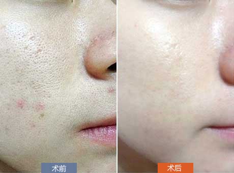 石家庄激光美白在什么时候做效果好呢