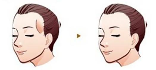 长沙额头填充效果好吗