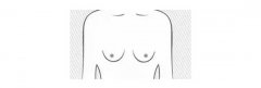 长沙巨乳缩小手术是怎样
