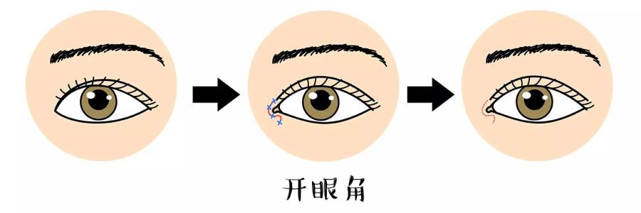 开眼角