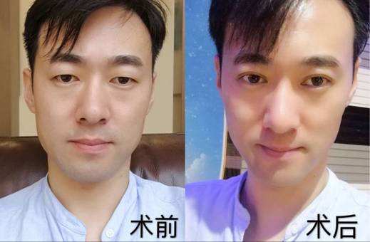 南京男士割双眼皮效果好不好呢