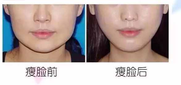 深圳利来国际瘦脸