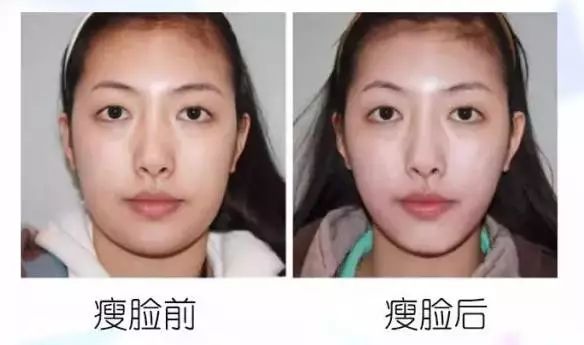 深圳利来国际瘦脸