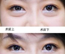 武汉利来国际怎样有效祛除眼袋