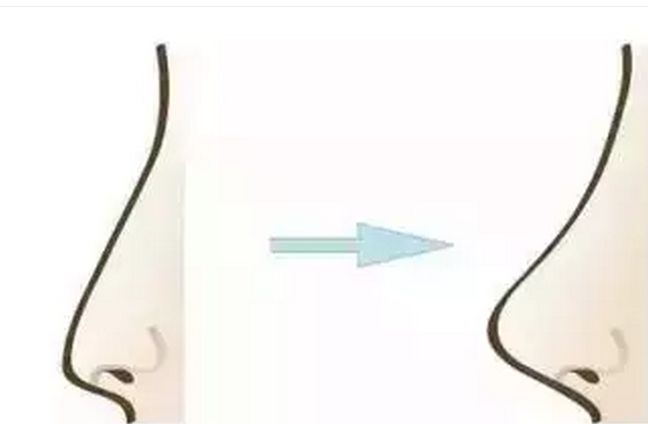 鼻部整形多少钱