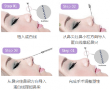 什么人适合做提升鼻？鼻头大可以做吗