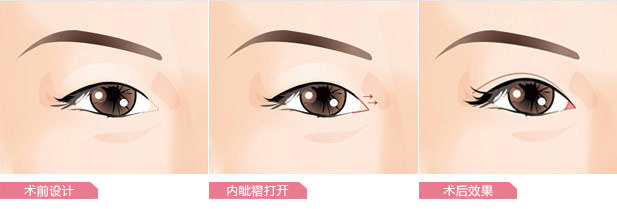 开眼角手术需要多久能恢复