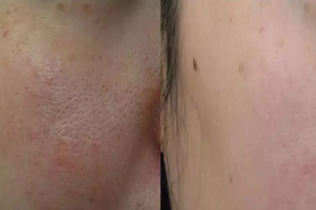 彩光嫩肤收缩脸上毛孔效果怎么样