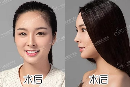 鼻子1个部位整得好