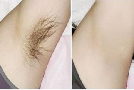 唇部冰点脱毛