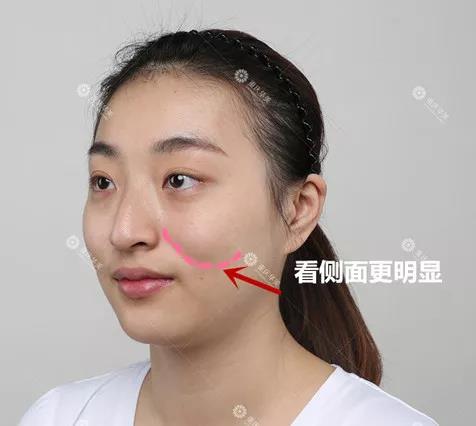 苹果肌脂肪填充