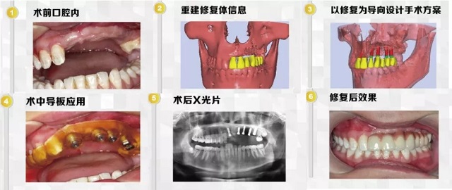 利来国际数字化微创种植