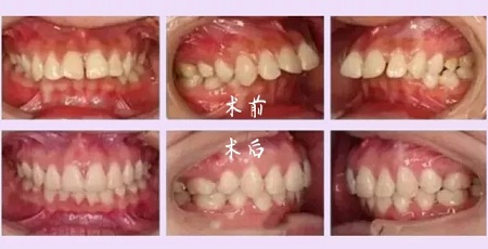 牙齿矫正