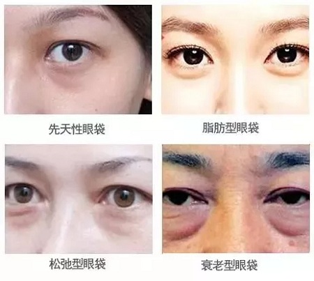 眼袋对比