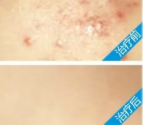 白瓷娃娃治疗