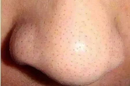 你知道脸上的黑头和白头是怎么形成的吗？