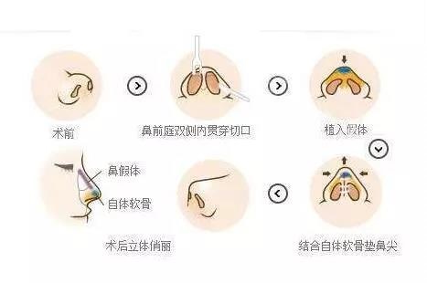 手术隆鼻