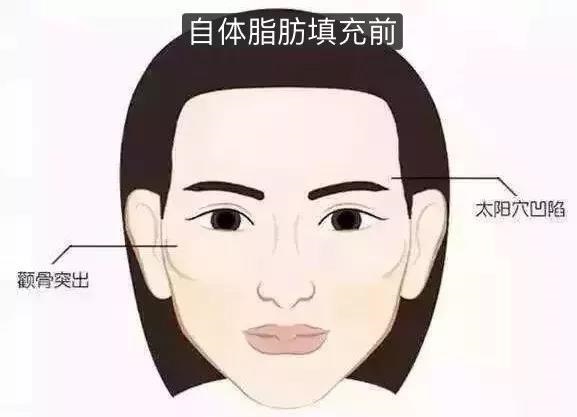 自体脂肪填充