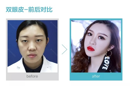 做了双眼皮，医师为什么建议要多睁眼？
