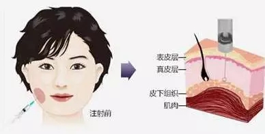 瘦脸会导致脸部凹陷松弛？