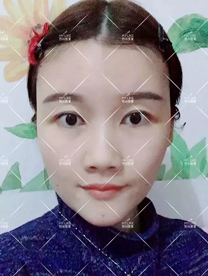 面部填充会不会把脸填大？