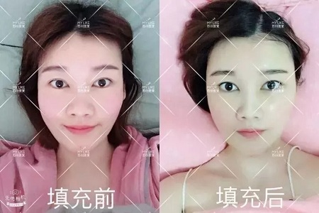 面部填充会不会把脸填大？
