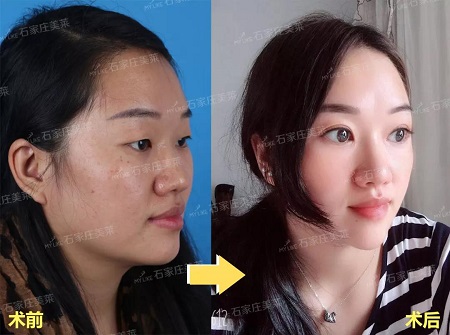 双眼皮