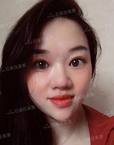 双眼皮