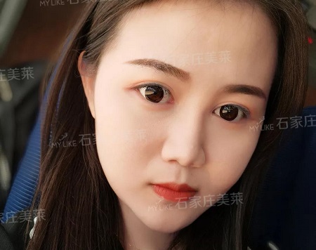 双眼皮