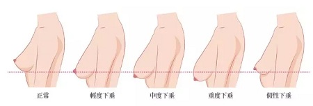 一味追求大胸的她们，却忽略了这个问题...
